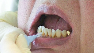 Zahnzwischenraumpflege: Zahnzwischenraumbürste bzw. Interdentalbürste nur dort, wo sich die Bürste ohne großen Widerstand einführen lässt. Die Bürsten gibt es meist in verschiedenen Größen, es sollten aus Gründen der Praktikabilität maximal zwei Größen zum Einsatz kommen.