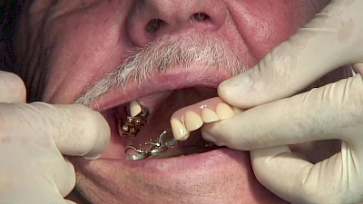 Beispiele: Aus- & Eingliederung von Zahnprothesen