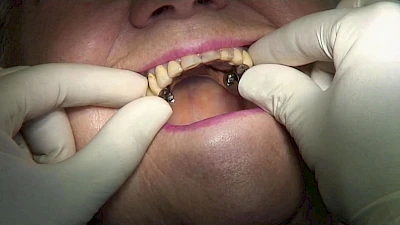 Beispiele: Aus- & Eingliederung von Zahnprothesen