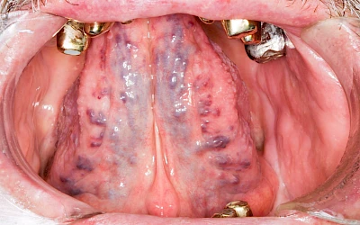 Beispiele: Venektasie & Venöse Stauung