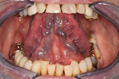 Beispiele: Venektasie & Venöse Stauung