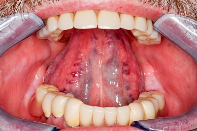 Beispiele: Venektasie & Venöse Stauung