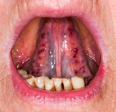 Beispiele: Venektasie & Venöse Stauung