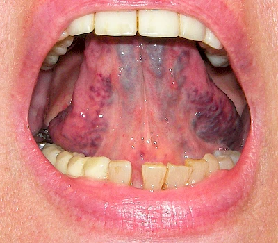 Beispiele: Venektasie & Venöse Stauung