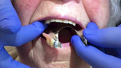 Beispiele: Aus- & Eingliederung von Zahnprothesen