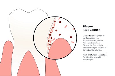 Plaque nach 24:00 h