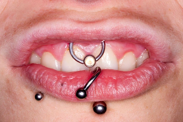 Auffälligkeiten im Mund Schmuck