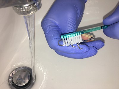 Bei Klammerprothesen werden die Klammern von "unten" mit dem Finger gesichert. So kann verhindert werden, dass die Borsten der Bürste in den Klammern verhaken und so die Prothese aus der Hand "reißen".