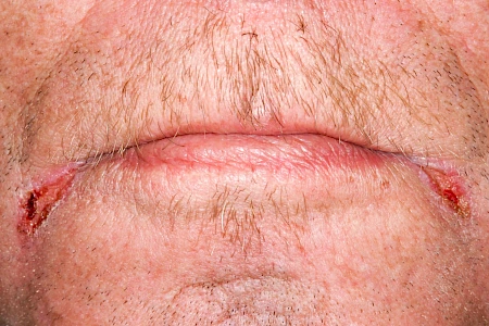 Gesunde Lippen