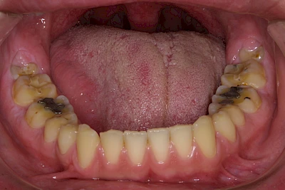 Beispiele: Auswaschung