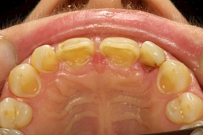 Beispiele: Auswaschung