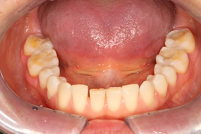 Beispiele: Auswaschung