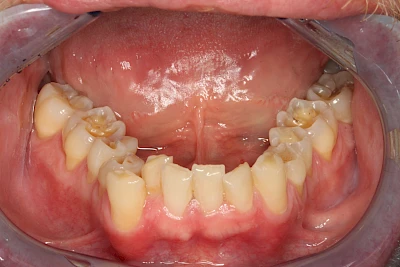 Beispiele: Auswaschung