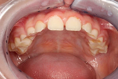 Beispiele: Auswaschung