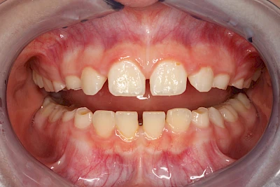 Beispiele: Auswaschung