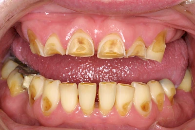 Beispiele: Auswaschung