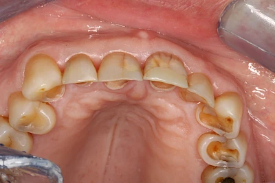 Beispiele: Auswaschung