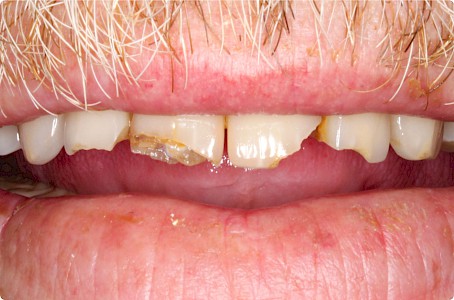 Absplitterung Zahn