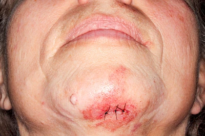 Beispiel: Sturz