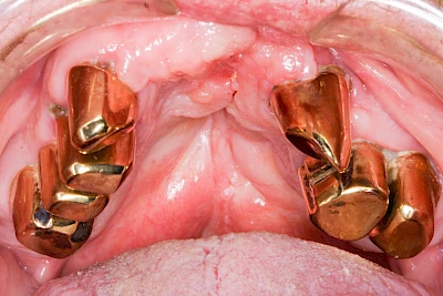 Beispiele: Lippen-Kiefer-Gaumenspalte