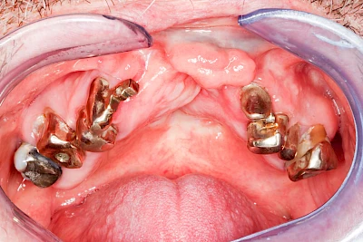 Beispiele: Lippen-Kiefer-Gaumenspalte