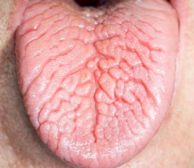 Beispiele: Faltenzunge