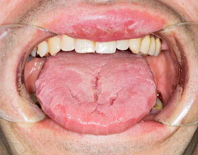 Beispiele: Faltenzunge