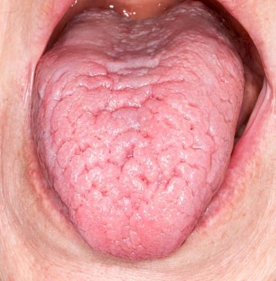 Beispiele: Faltenzunge