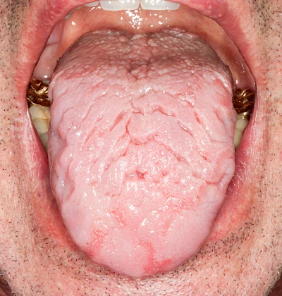 Beispiele: Faltenzunge