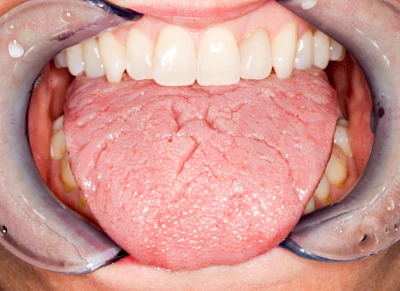 Beispiele: Faltenzunge