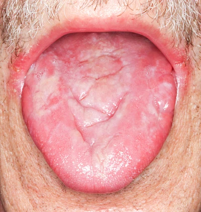 Beispiele: Faltenzunge