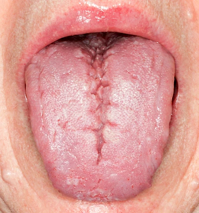 Beispiele: Faltenzunge