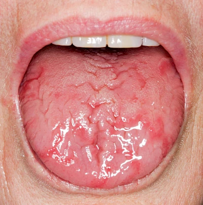 Beispiele: Faltenzunge