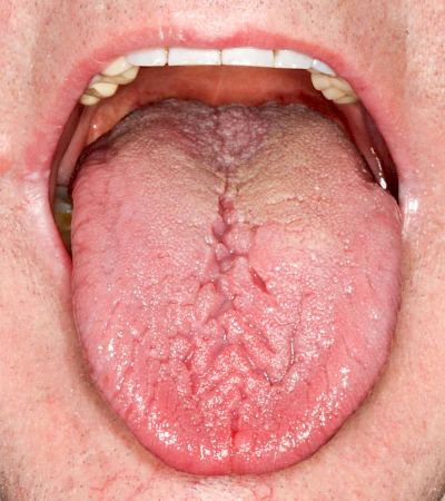 Beispiele: Faltenzunge