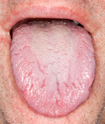 Beispiele: Faltenzunge