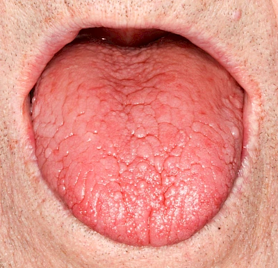 Beispiele: Faltenzunge