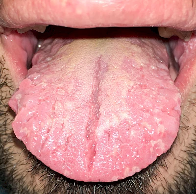 Beispiele: Faltenzunge