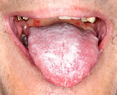 Beispiele: Haarzunge