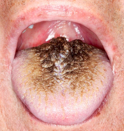 Beispiele: Haarzunge