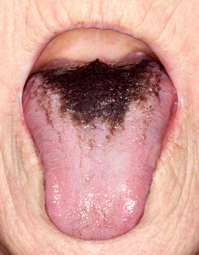 Beispiele: Haarzunge