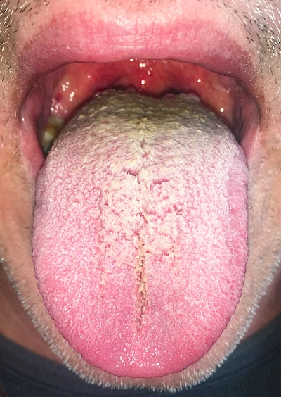 Beispiele: Haarzunge