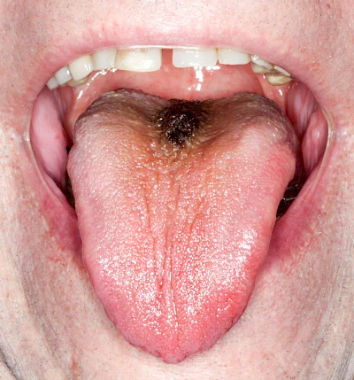 Beispiele: Haarzunge