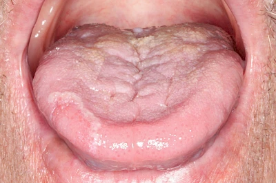 Beispiele: Landkartenzunge