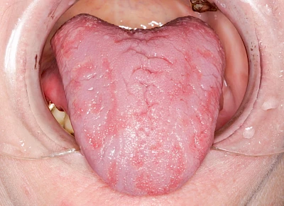 Beispiele: Landkartenzunge