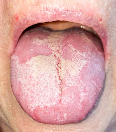 Beispiele: Landkartenzunge