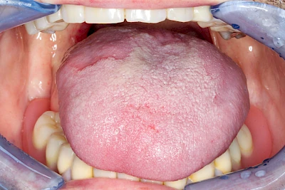 Beispiele: Landkartenzunge