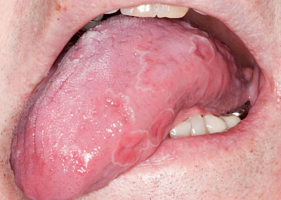 Beispiele: Landkartenzunge