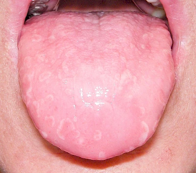 Beispiele: Landkartenzunge