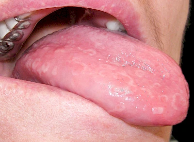 Beispiele: Landkartenzunge