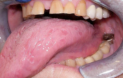 Beispiele: Landkartenzunge